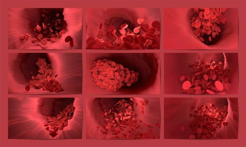 Deep vein thrombosis (DVT) is a serious condition in which a blood clot forms in a deep vein in your body. We wanted to learn more about the association between anxiety and depresion and DVT and understand the potential mechanisms behind this association.